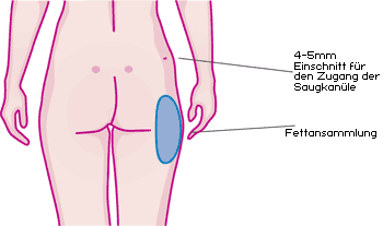 Fettabsaugung - Liposuktion - Gyn&auml;komastie